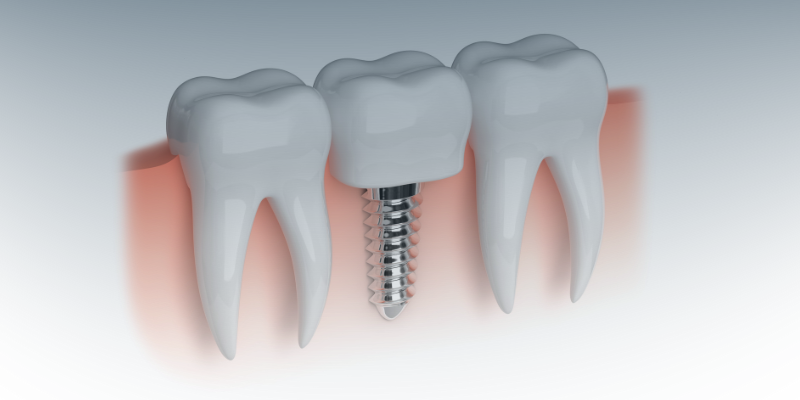 Como-limpar-o-implante-2 Como Limpar um Implante Dentário: Guia dos Cuidados Diários