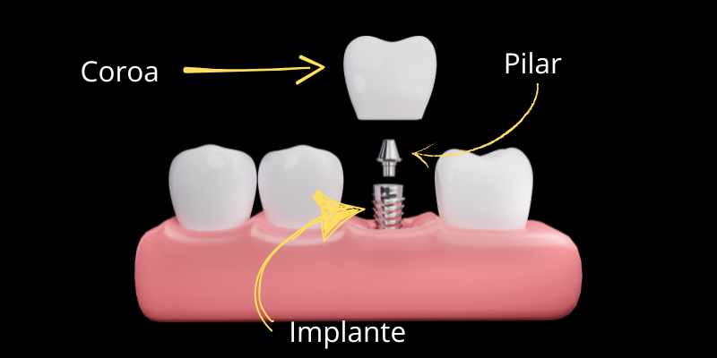 Implante-Dentario-Unitario Implante Dentário Unitário, O que é?