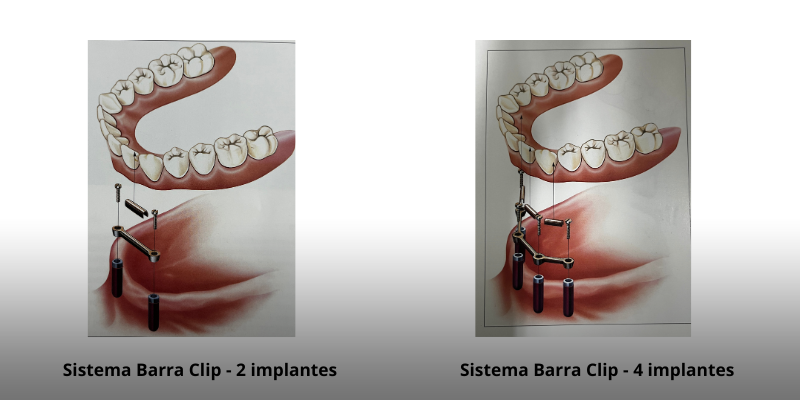 Overdenture-sobre-implante-2 Tudo sobre Overdenture sobre Implantes