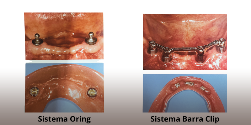 Overdenture-sobre-implante-3 Tudo sobre Overdenture sobre Implantes