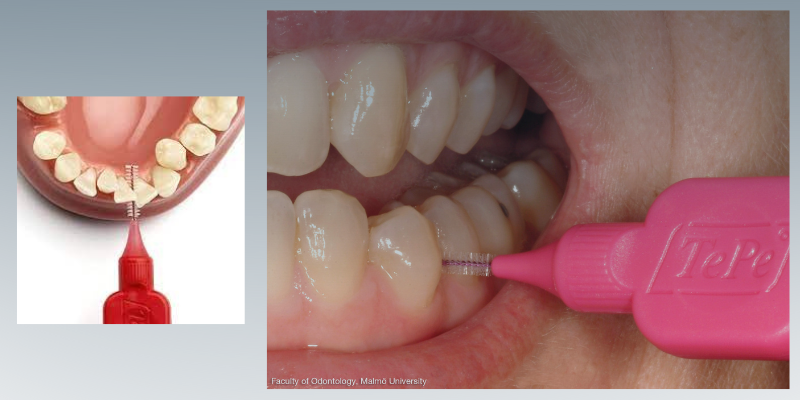 como-limpar-o-implante-dentario-4 Como Limpar um Implante Dentário: Guia dos Cuidados Diários