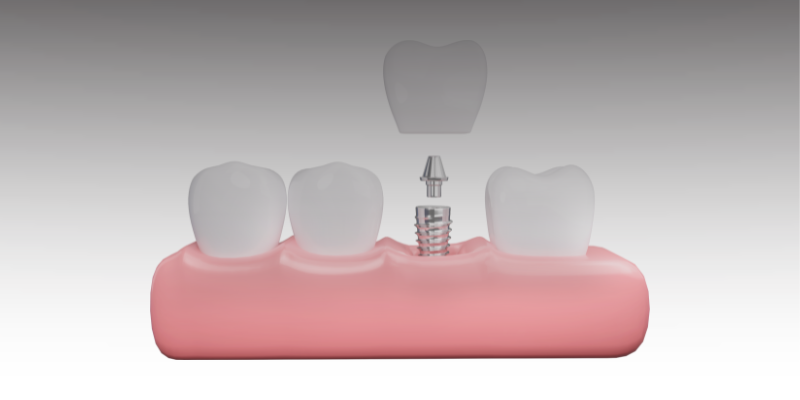 Carga-imediata-2 Implante Dentário em Apenas Um Dia: É Mesmo Possível?